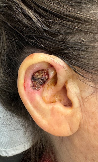 Mohs Facial Reconstruction  Before & After Gallery - Patient 247123 - Image 1