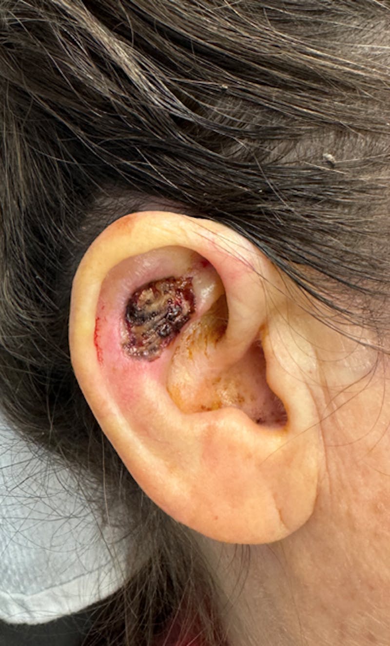 Mohs Facial Reconstruction  Before & After Gallery - Patient 247123 - Image 1