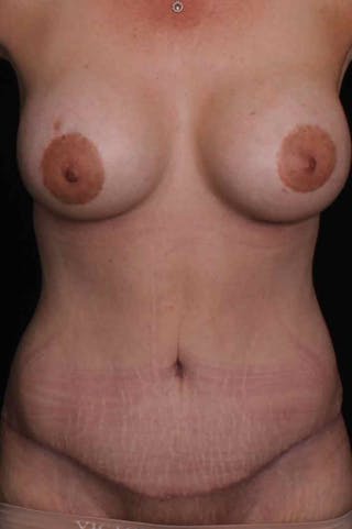 Abdominoplasty Before & After Gallery - Patient 383155 - Image 2