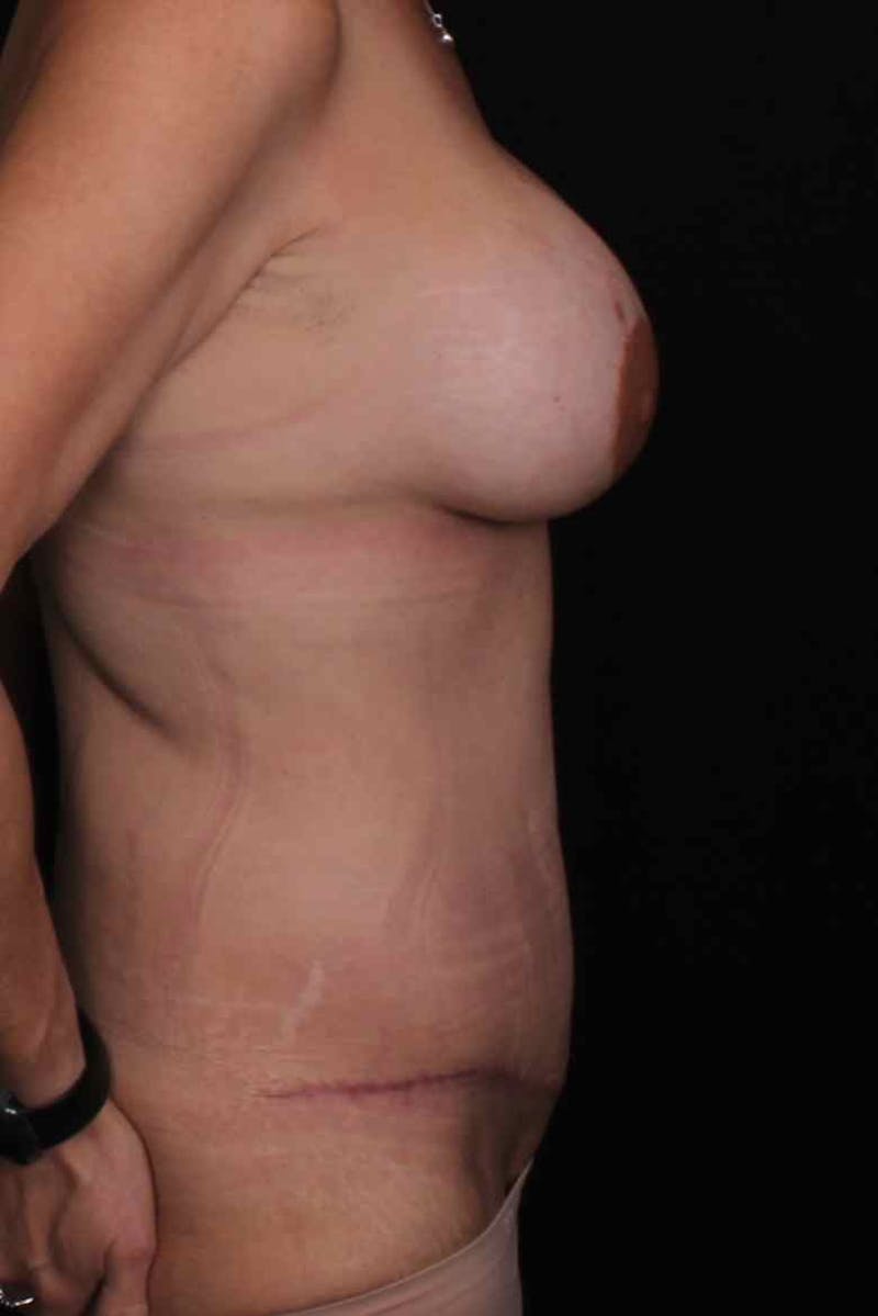Abdominoplasty Before & After Gallery - Patient 383155 - Image 6