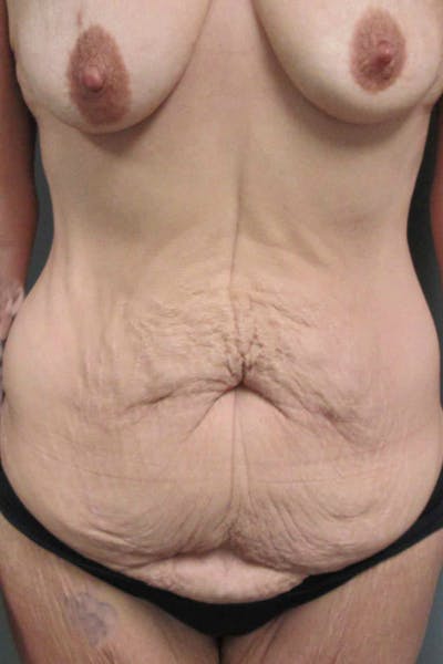 Abdominoplasty Before & After Gallery - Patient 383155 - Image 1
