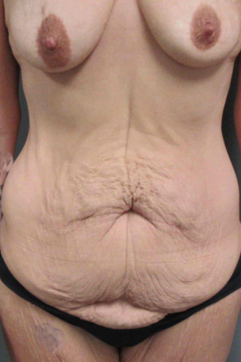 Abdominoplasty Before & After Gallery - Patient 383155 - Image 1