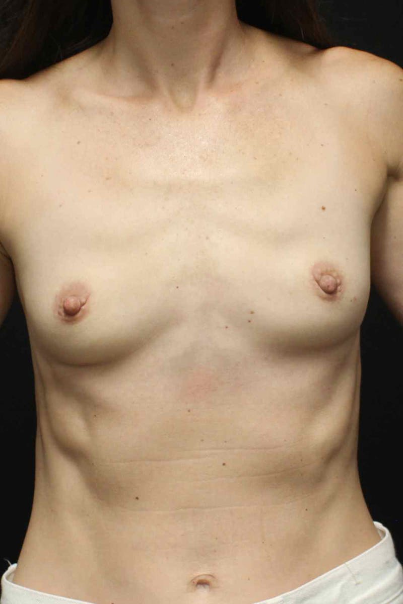 Breast Augmentation Before & After Gallery - Patient 311071 - Image 1
