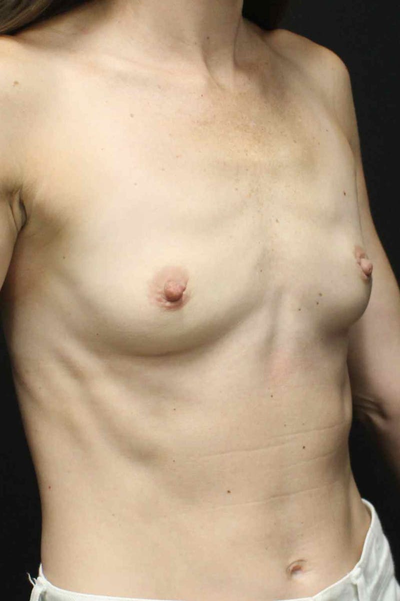 Breast Augmentation Before & After Gallery - Patient 311071 - Image 3
