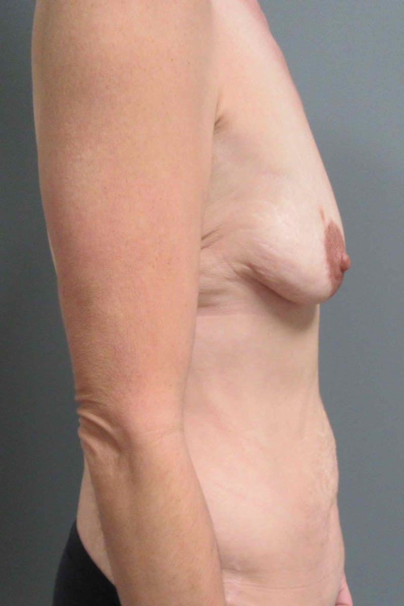 Breast Augmentation Before & After Gallery - Patient 395800 - Image 5