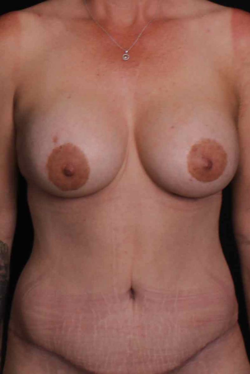 Breast Augmentation Before & After Gallery - Patient 395800 - Image 2