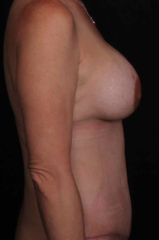 Breast Augmentation Before & After Gallery - Patient 395800 - Image 6