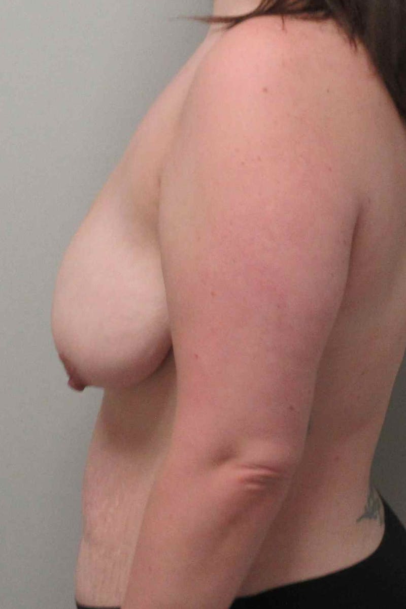 Breast Augmentation with Lift Before & After Gallery - Patient 402695 - Image 5