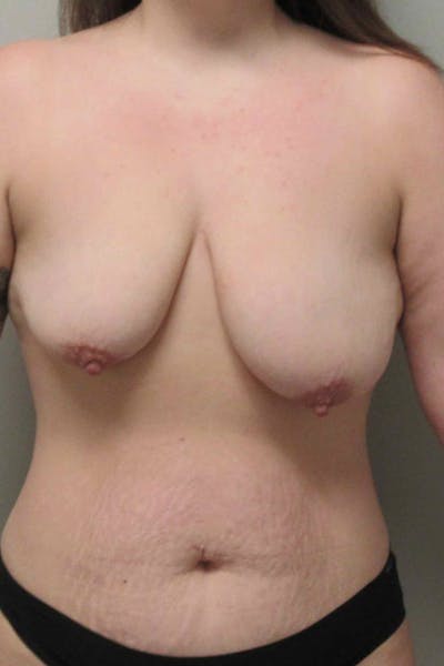 Breast Augmentation with Lift Before & After Gallery - Patient 402695 - Image 1