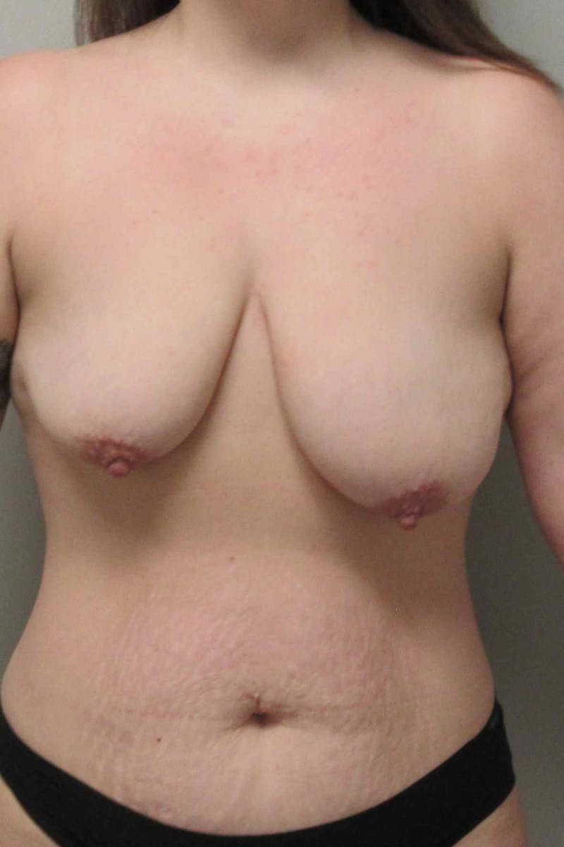 Breast Augmentation with Lift Before & After Gallery - Patient 402695 - Image 1