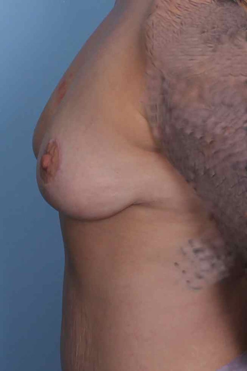 Breast Augmentation with Lift Before & After Gallery - Patient 402695 - Image 6