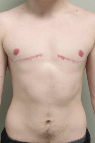 FTM Top Surgery Before & After Gallery - Patient 173908 - Image 2