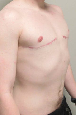 FTM Top Surgery Before & After Gallery - Patient 173908 - Image 4