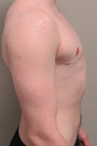 FTM Top Surgery Before & After Gallery - Patient 173908 - Image 6