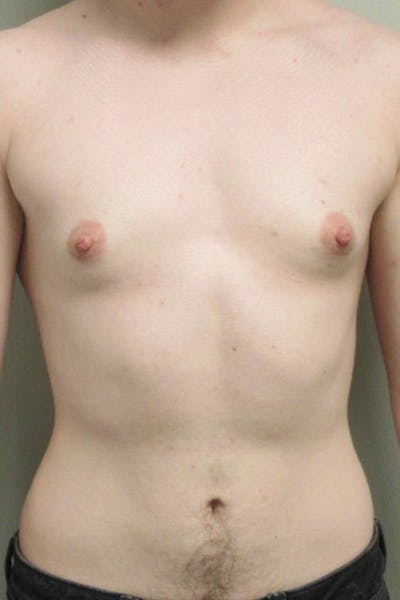 FTM Top Surgery Before & After Gallery - Patient 173908 - Image 1