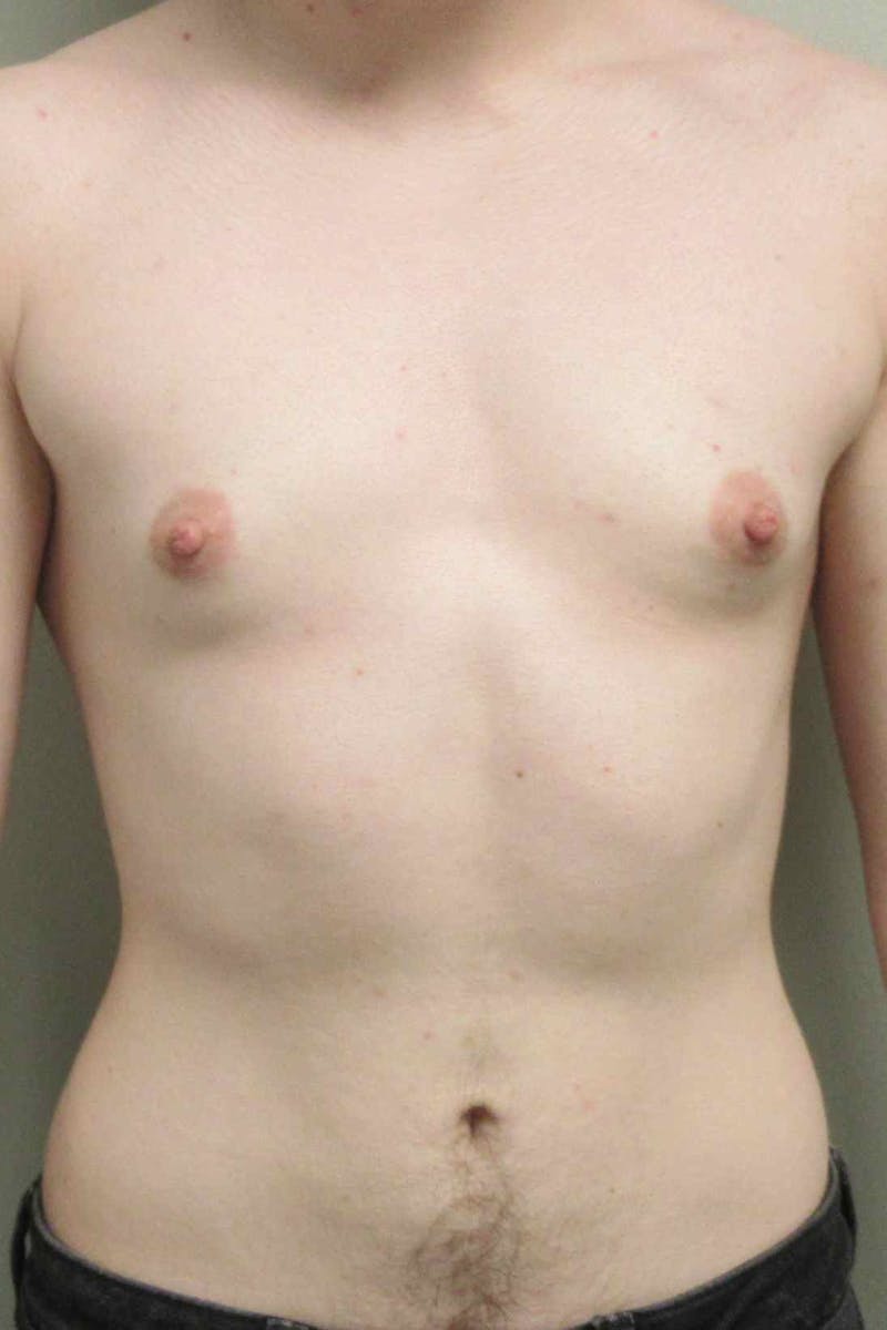 FTM Top Surgery Before & After Gallery - Patient 173908 - Image 1