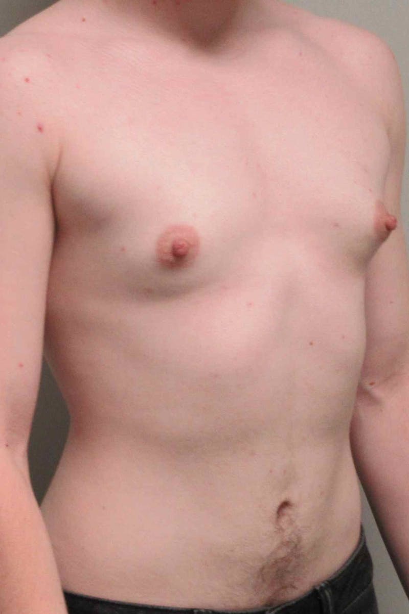 FTM Top Surgery Before & After Gallery - Patient 173908 - Image 3