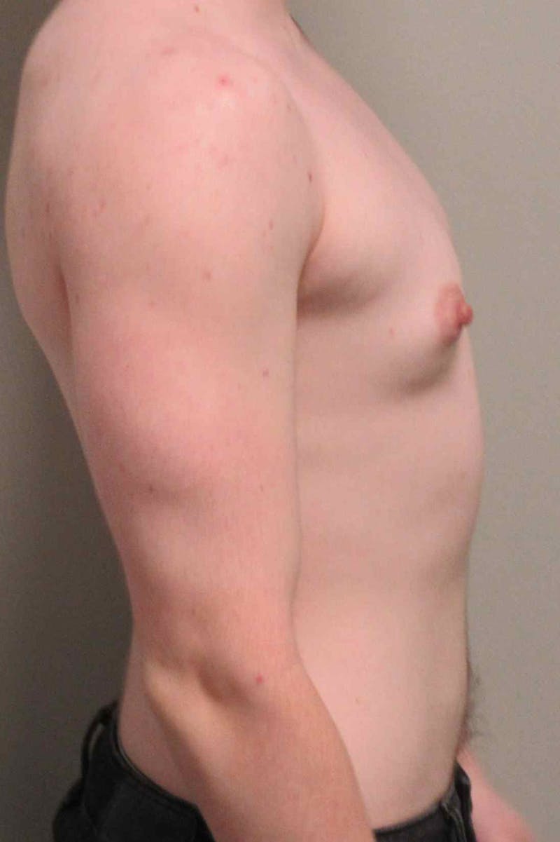 FTM Top Surgery Before & After Gallery - Patient 173908 - Image 5