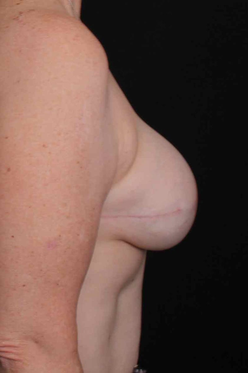 Breast Reconstruction Revision Before & After Gallery - Patient 223935 - Image 6