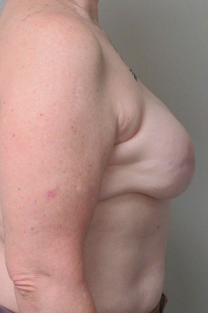 Breast Reconstruction Revision Before & After Gallery - Patient 223935 - Image 5