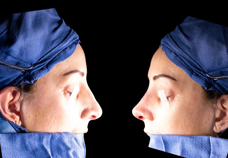 Rhinoplasty Before & After Gallery - Patient 304119 - Image 7