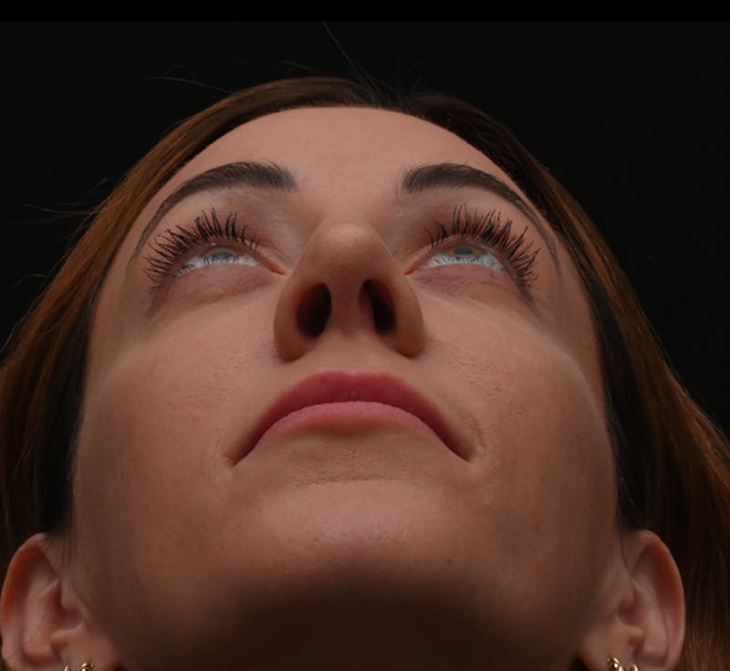 Rhinoplasty Before & After Gallery - Patient 304119 - Image 6