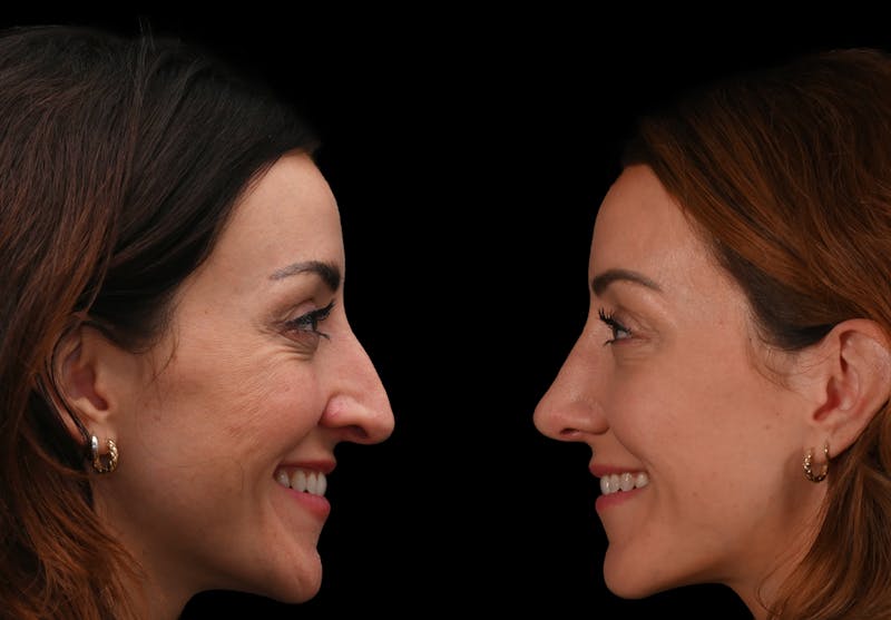 Rhinoplasty Before & After Gallery - Patient 304119 - Image 8
