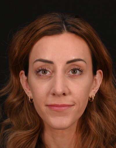 Rhinoplasty Before & After Gallery - Patient 304119 - Image 2
