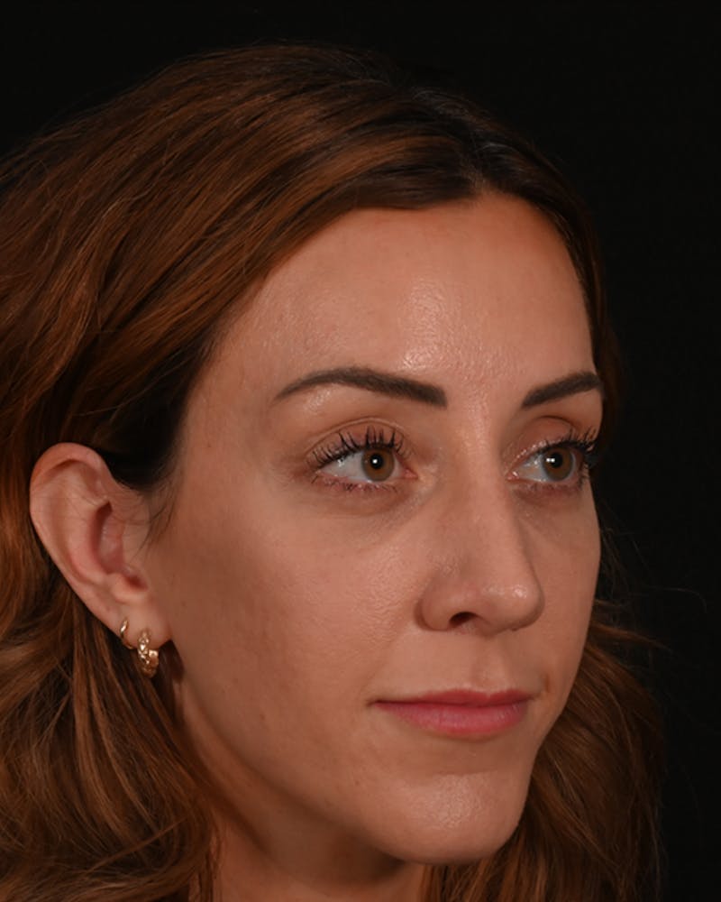 Rhinoplasty Before & After Gallery - Patient 304119 - Image 10