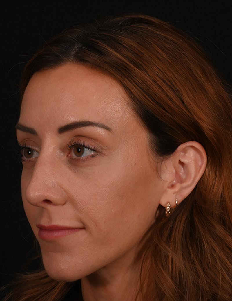 Rhinoplasty Before & After Gallery - Patient 304119 - Image 12