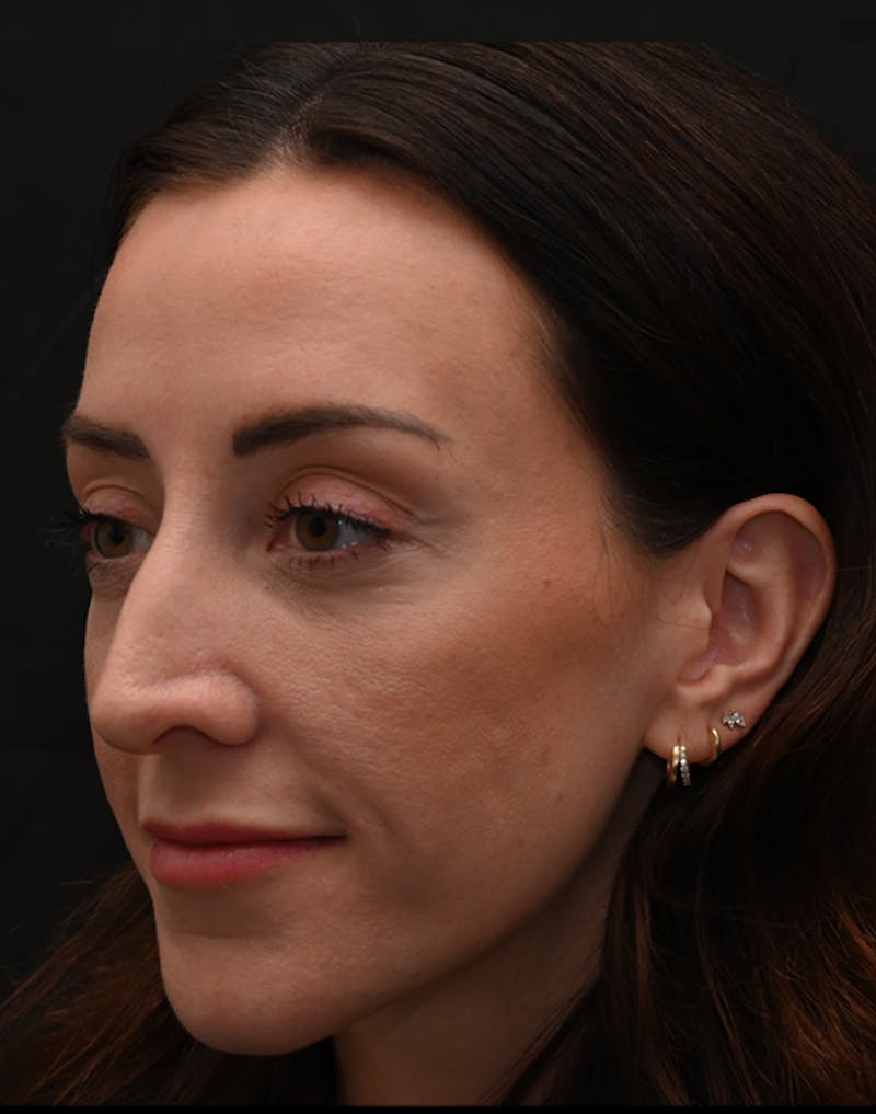 Rhinoplasty Before & After Gallery - Patient 304119 - Image 11