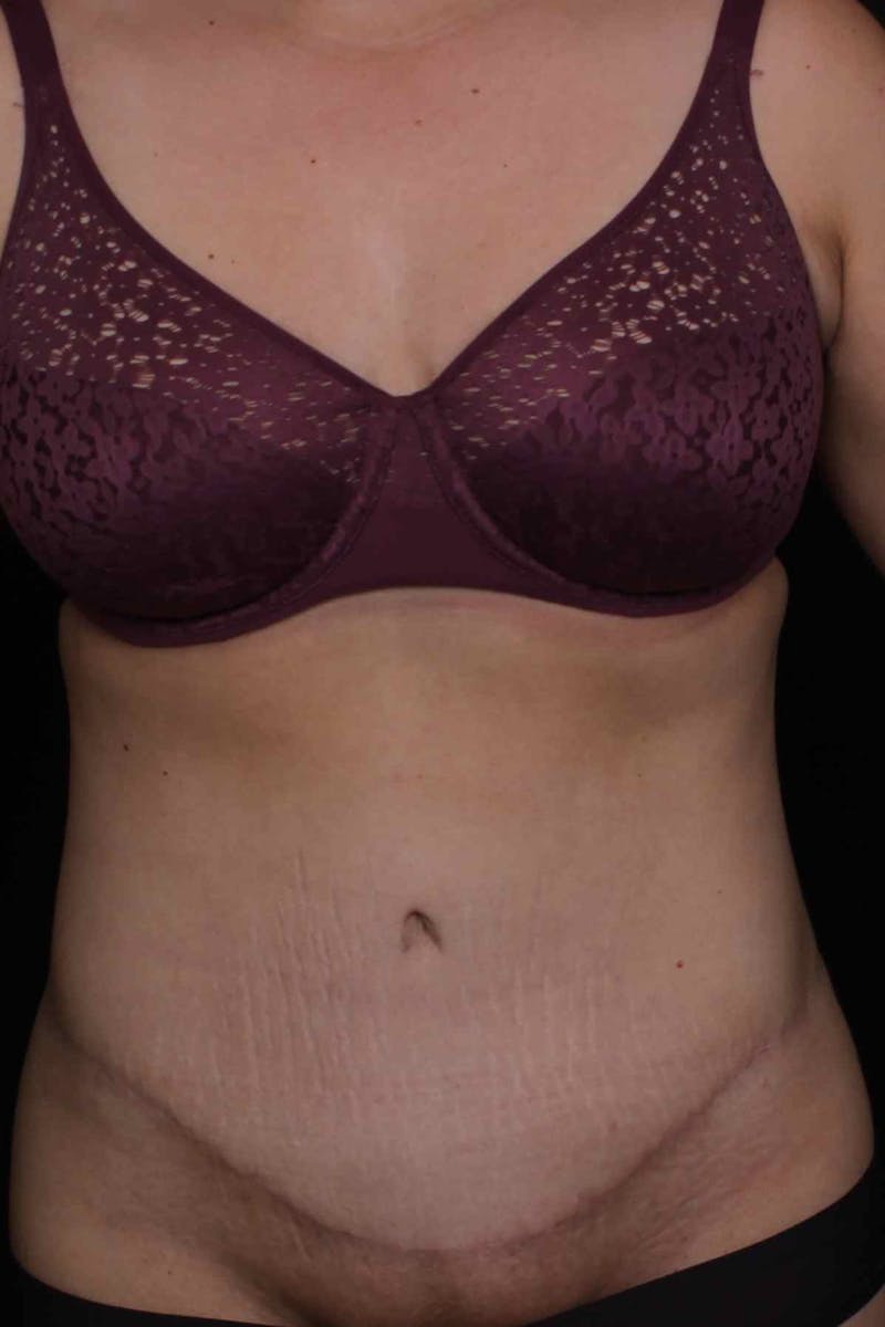Abdominoplasty Before & After Gallery - Patient 407885 - Image 2