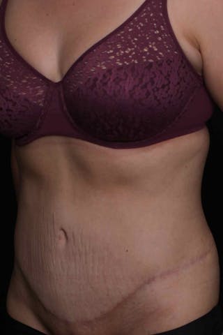 Abdominoplasty Before & After Gallery - Patient 407885 - Image 4