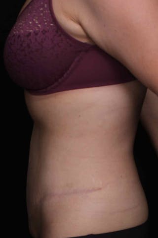 Abdominoplasty Before & After Gallery - Patient 407885 - Image 6
