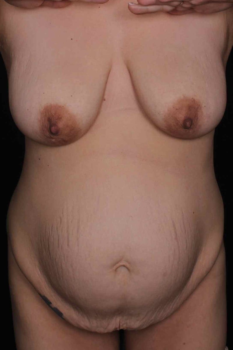 Abdominoplasty Before & After Gallery - Patient 407885 - Image 1