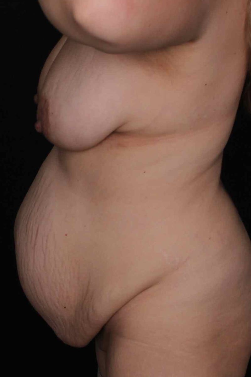 Abdominoplasty Before & After Gallery - Patient 407885 - Image 5