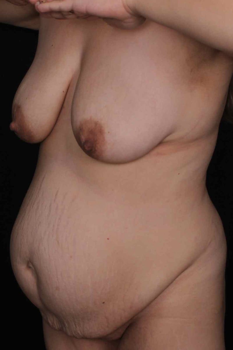Abdominoplasty Before & After Gallery - Patient 407885 - Image 3