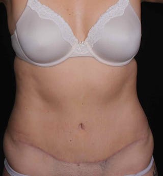 Abdominoplasty Before & After Gallery - Patient 399794 - Image 2