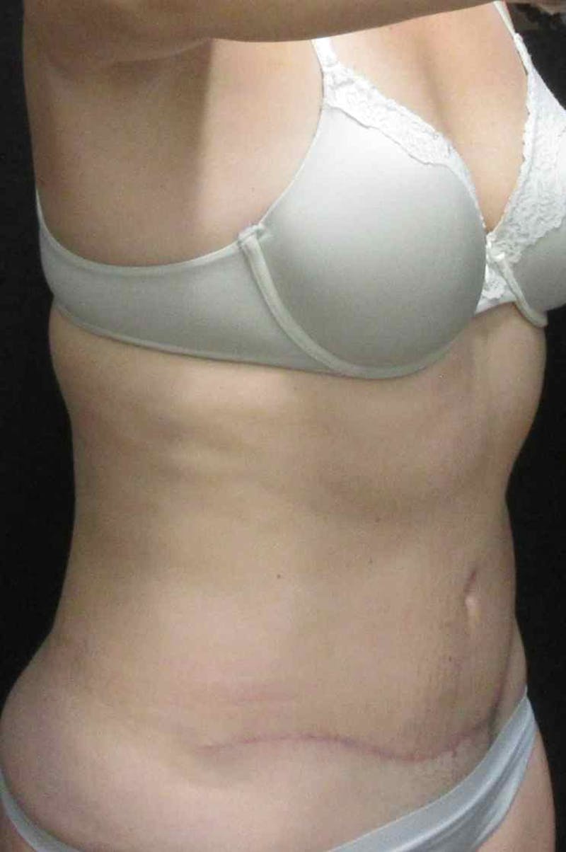 Abdominoplasty Before & After Gallery - Patient 399794 - Image 4