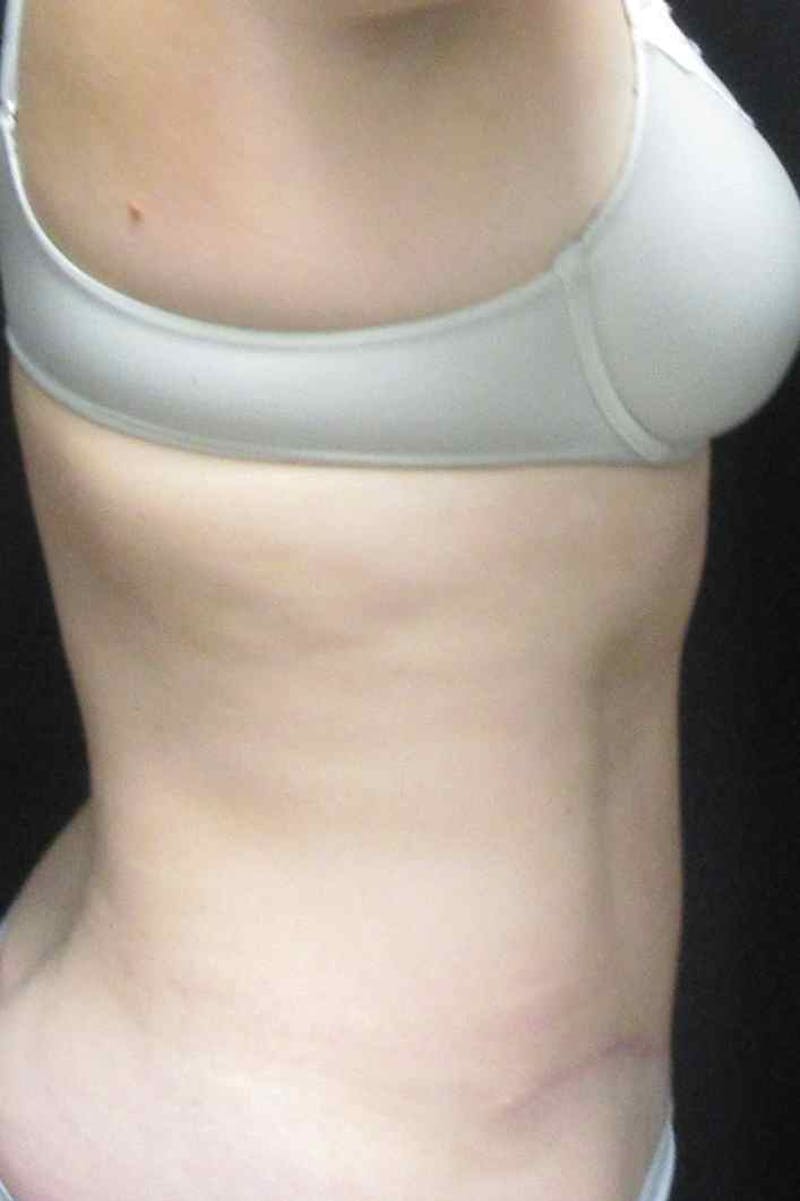 Abdominoplasty Before & After Gallery - Patient 399794 - Image 6