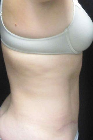 Abdominoplasty Before & After Gallery - Patient 399794 - Image 6