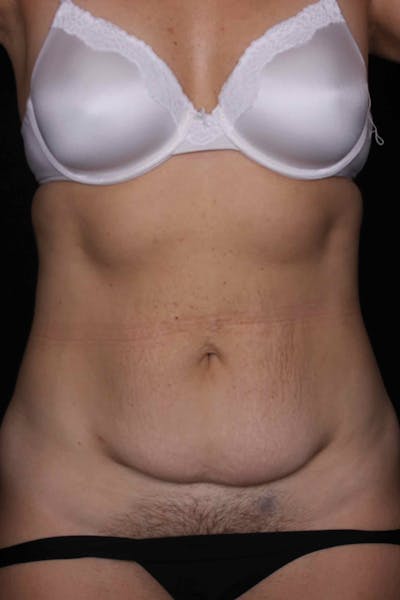 Abdominoplasty Before & After Gallery - Patient 399794 - Image 1