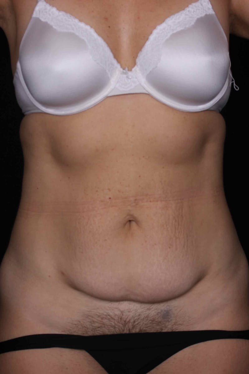 Abdominoplasty Before & After Gallery - Patient 399794 - Image 1