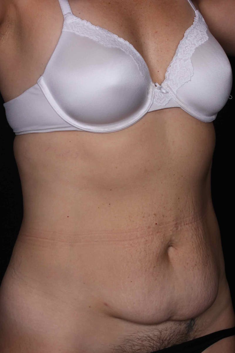 Abdominoplasty Before & After Gallery - Patient 399794 - Image 3