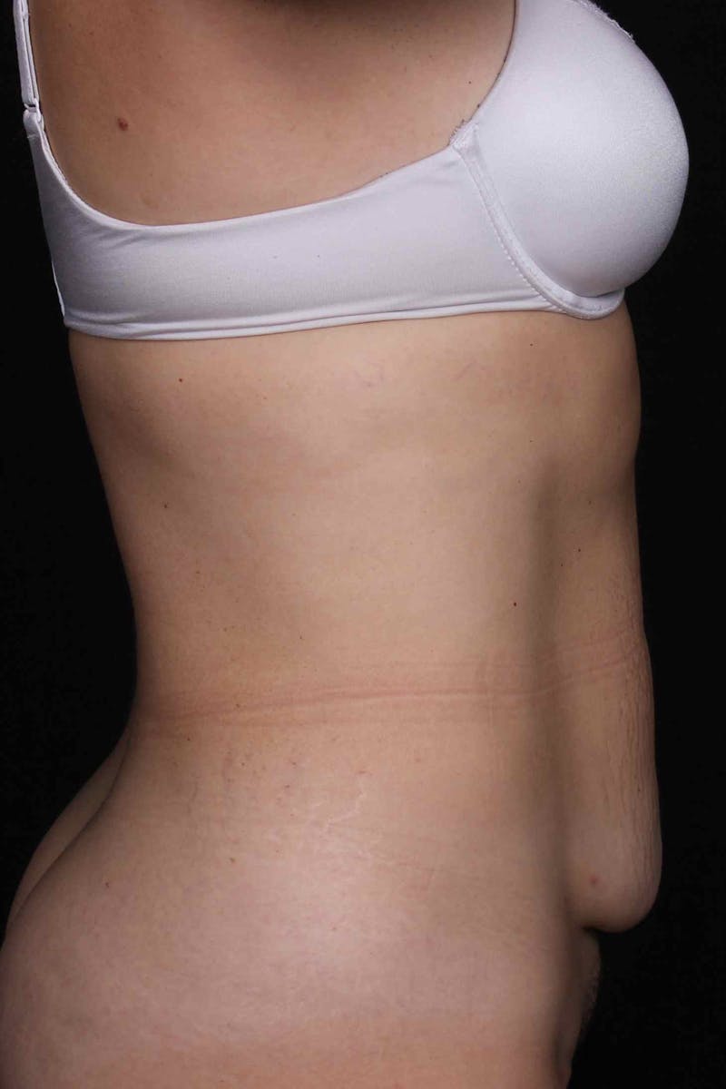 Abdominoplasty Before & After Gallery - Patient 399794 - Image 5