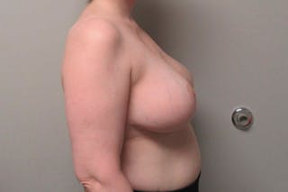 Breast Reduction Before & After Gallery - Patient 370222 - Image 6