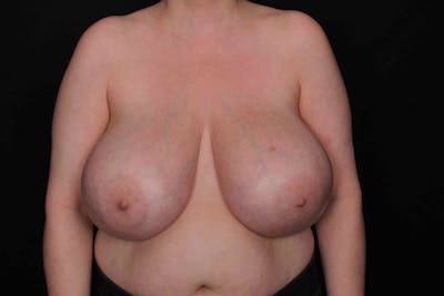 Breast Reduction Before & After Gallery - Patient 370222 - Image 1