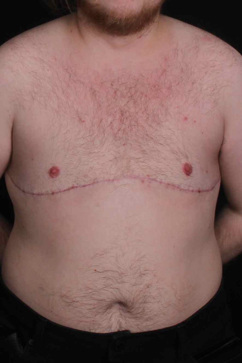 FTM Top Surgery Before & After Gallery - Patient 123340 - Image 2