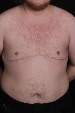 FTM Top Surgery Before & After Gallery - Patient 123340 - Image 2
