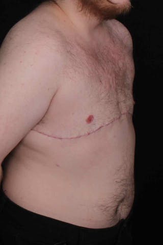 FTM Top Surgery Before & After Gallery - Patient 123340 - Image 4